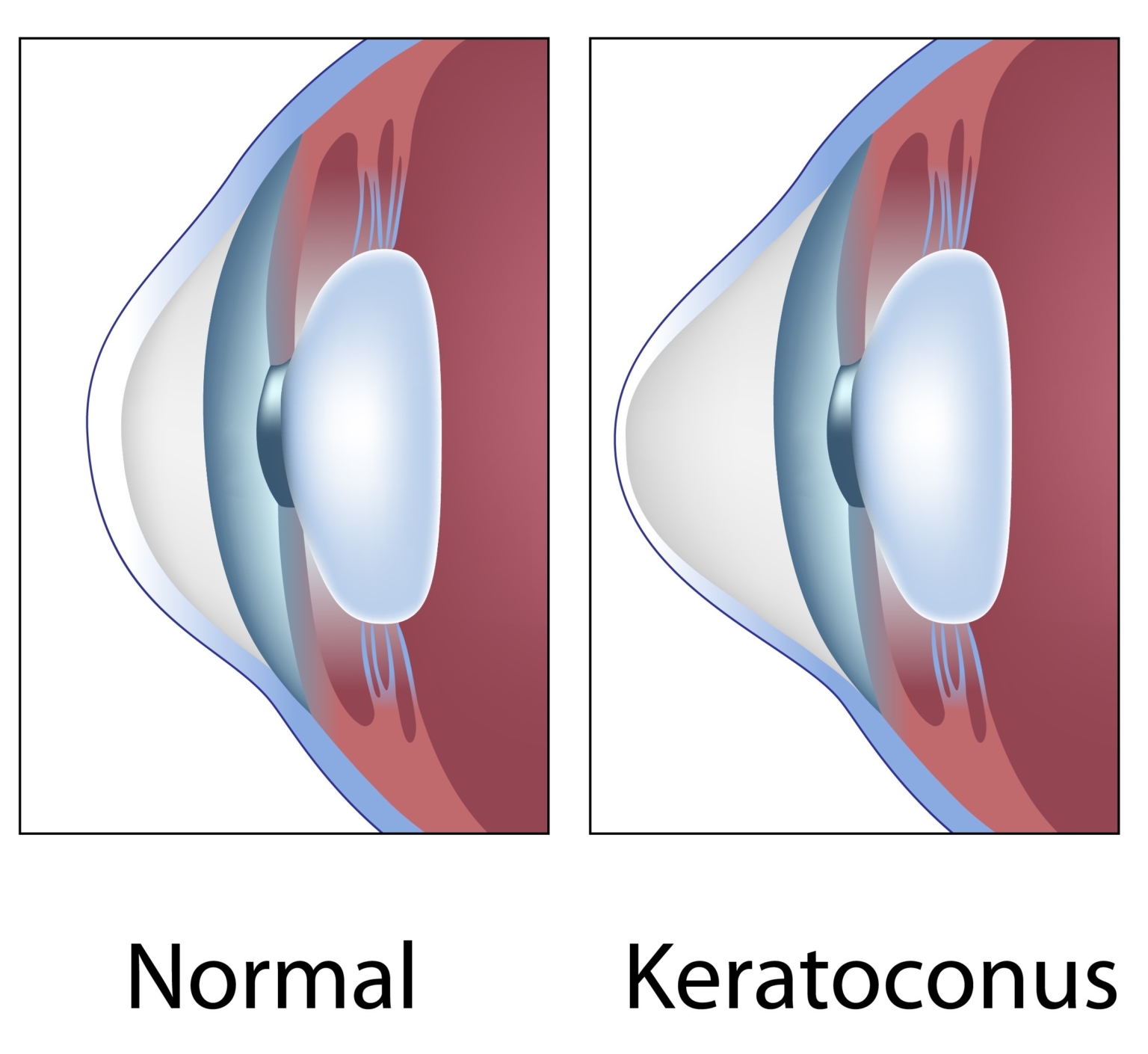 Scleral Contacts Keratoconus Info For Patients Bostonsight Scleral